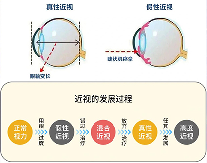 1764296501135739.jpg 真假近视.jpg